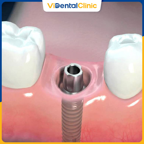 Trồng răng Implant không nguy hiểm nếu chọn nha khoa uy tín