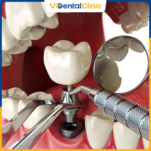 Trồng răng Implant có thể gặp biến chứng nếu bác sĩ thực hiện sai kỹ thuật