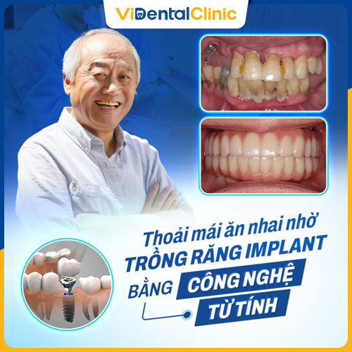 Nha Khoa ViDental là một địa chỉ trồng răng Implant đáng tin cậy