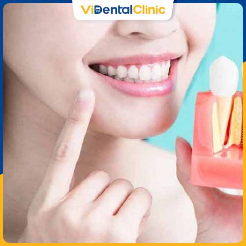Trồng răng có 3 phương pháp phổ biến
