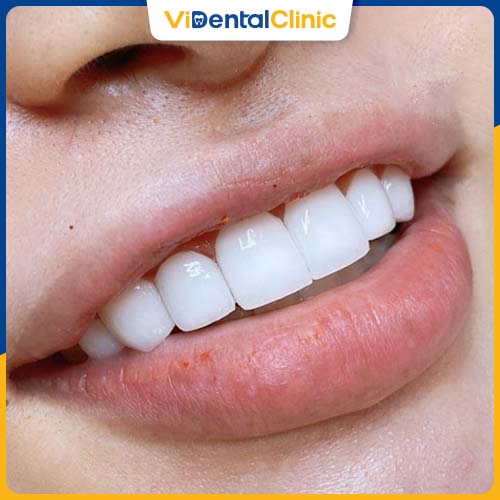 Răng sứ Cercon HT (High Translucent) là răng toàn sứ