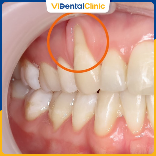 Việc sử dụng răng sứ giá rẻ có thể gây tụt lợi và viêm lợi