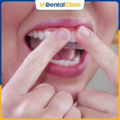 Miếng dán chỉ có tác dụng ở mặt trước của răng