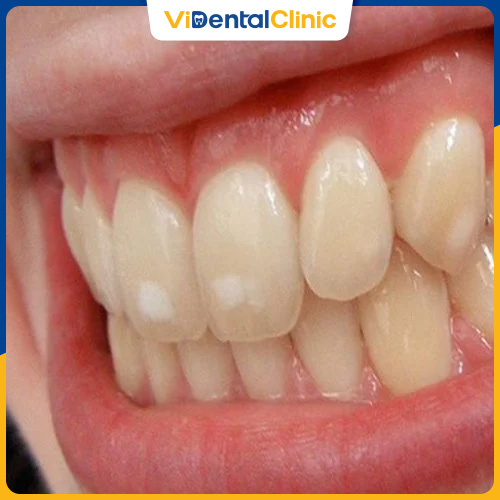 Răng bị nhiễm màu nặng nên bọc răng sứ