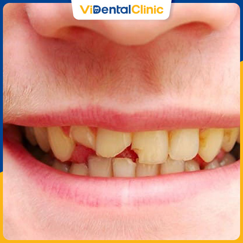 Đối với trường hợp răng bị mẻ nghiêm trọng, bọc răng sứ sẽ không đem lại hiệu quả cao