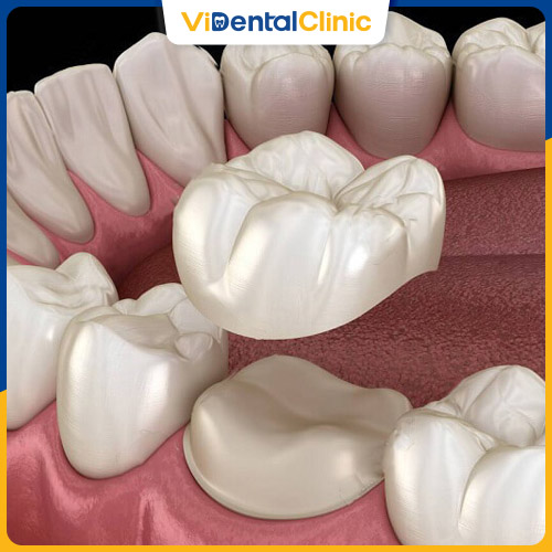 Quy trình tháo răng sứ gồm 5 bước chuẩn Y khoa