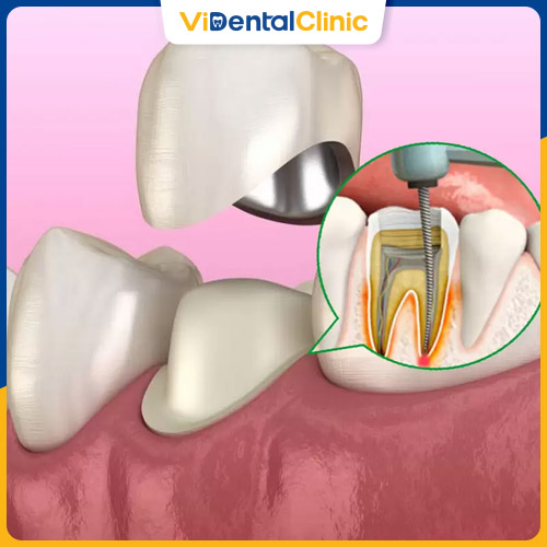 Bọc răng sứ sau khi lấy tủy giúp bảo tồn răng thật tối đa