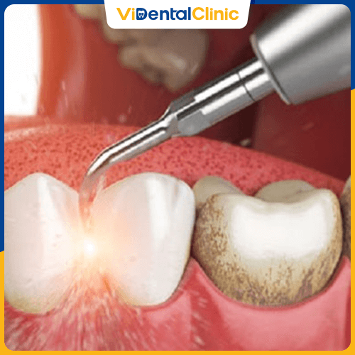 Đánh bóng răng loại bỏ mảng bám và bẩn trên bề mặt răng