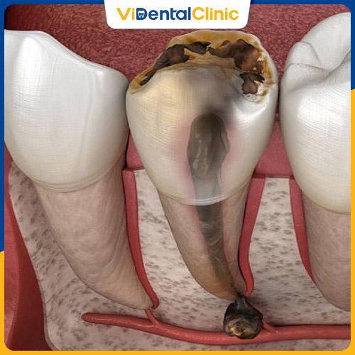 Răng sâu, hỏng tủy là trường hợp nên bọc răng sứ
